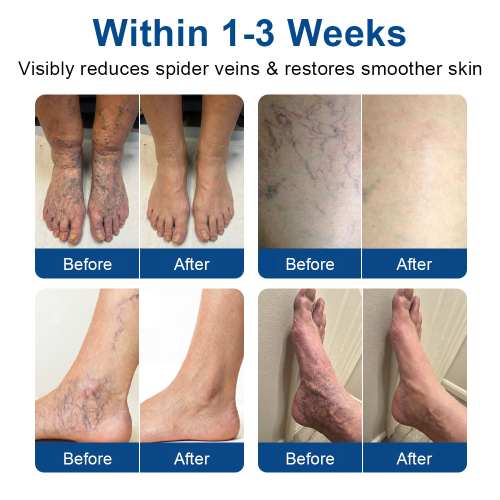 🇺🇸CareUplift® VeinTarget 🦵 Microneedle Patch – Relieves Leg Swelling & Varicose/Spider Veins ✅