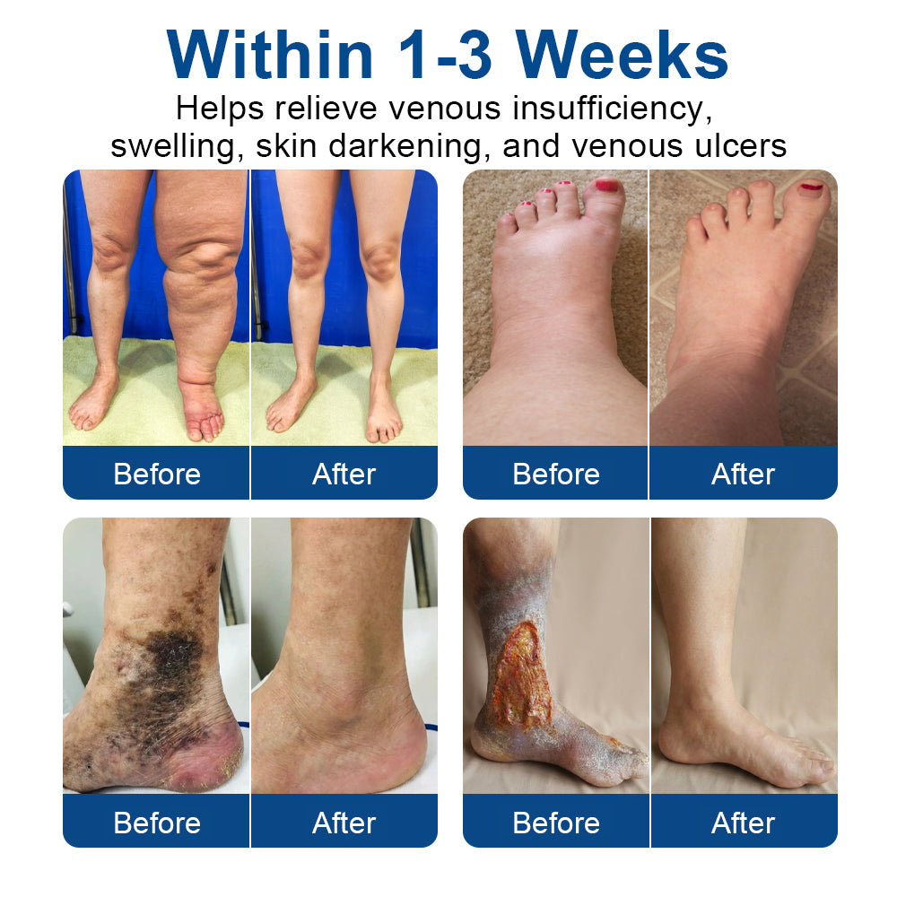 🇺🇸CareUplift® VeinTarget 🦵 Microneedle Patch – Relieves Leg Swelling & Varicose/Spider Veins ✅
