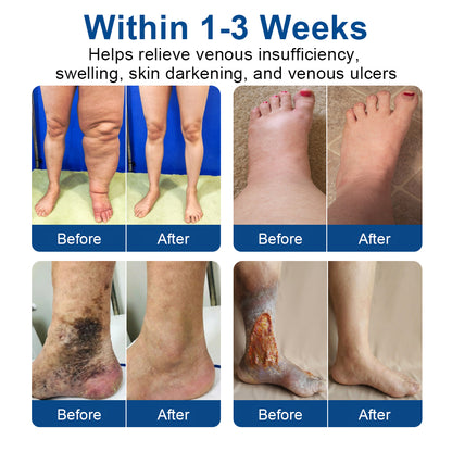 🇺🇸CareUplift® VeinTarget 🦵 Microneedle Patch – Relieves Leg Swelling & Varicose/Spider Veins ✅