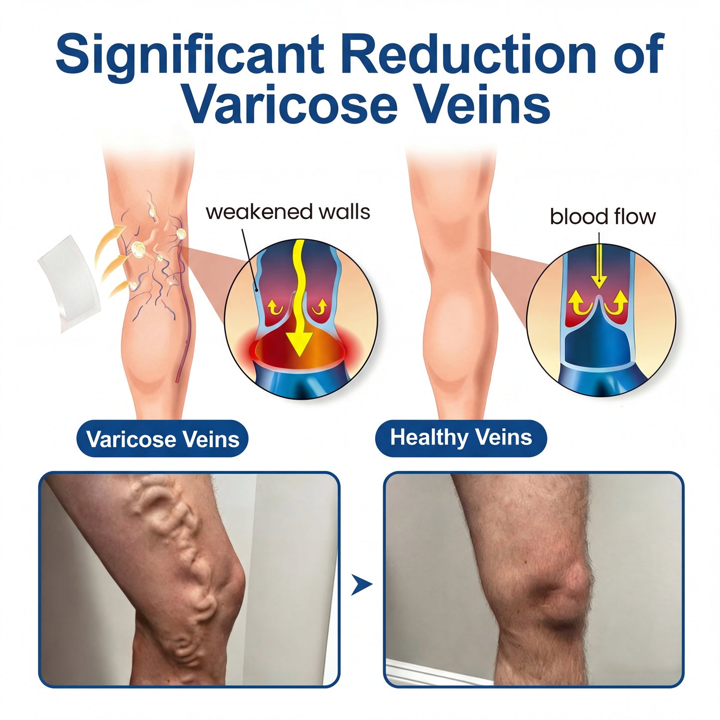 🇺🇸CareUplift® VeinTarget 🦵 Microneedle Patch – Relieves Leg Swelling & Varicose/Spider Veins ✅