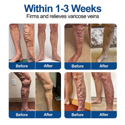 🇺🇸CareUplift® VeinTarget 🦵 Microneedle Patch – Relieves Leg Swelling & Varicose/Spider Veins ✅
